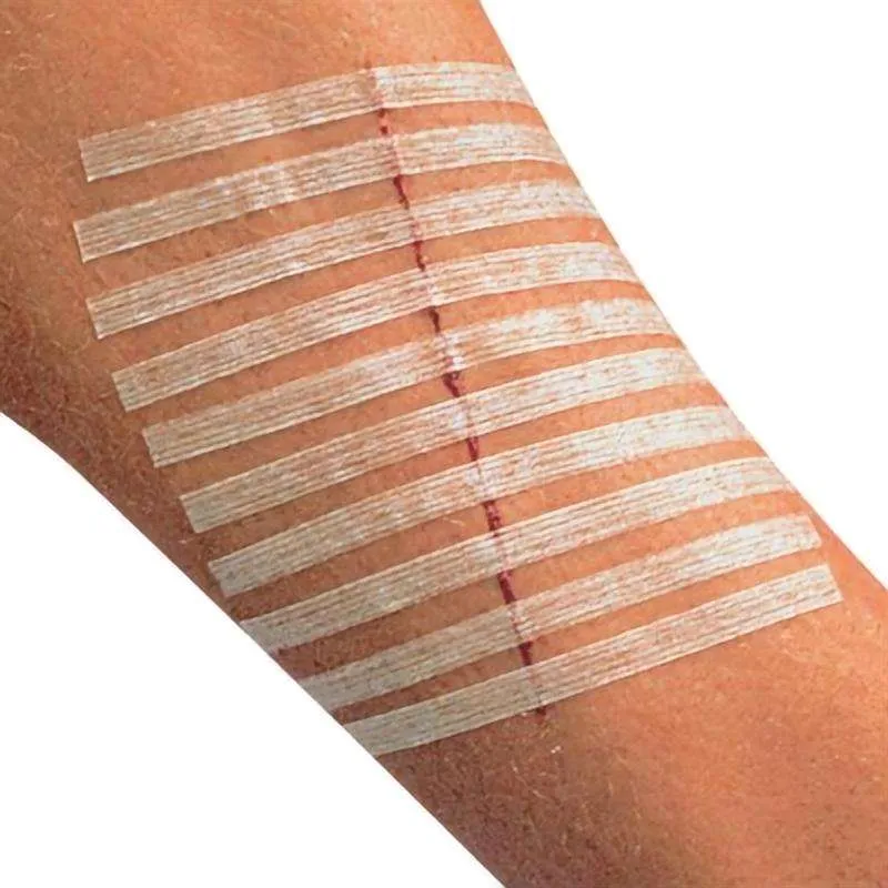 Disposable Sterile Wound Closure Device Skin Closure Strips for Laceration & Surgical Incision 5