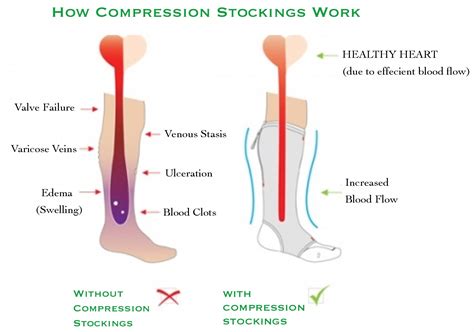 20-30mmHg medical nurse Pregnant varicose veins compression stocking socks pantyhose for man and woman 3