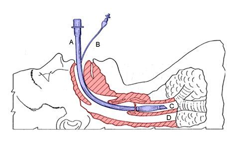 Disposable Medical PVC Endotracheal Tube With All Types And Sizes 8