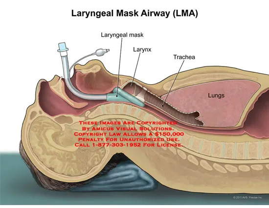 Disposable Medical Silicone/PVC Laryngeal mask 7