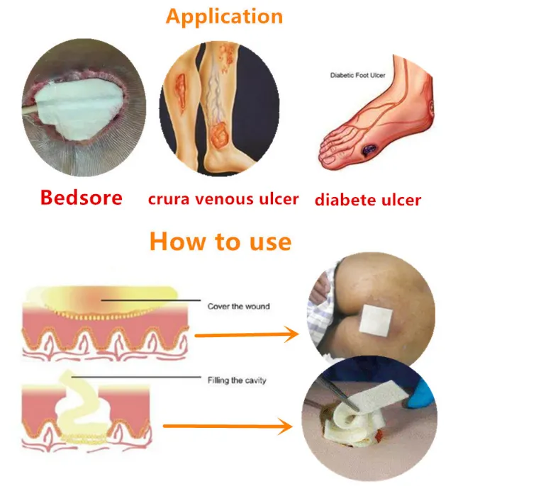 Absorbent Surgical Medical Calcium Bedsore Burn Sodium Alginate Wound Dressing 12