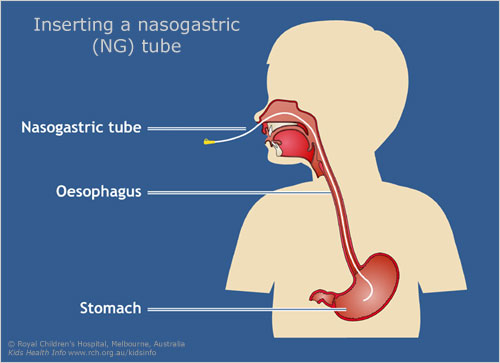 Disposable medical PVC feeding tube with FDA,CE,ISO 6
